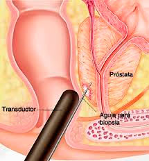 Interventiile chirurgicale pentru afectiunile prostatei